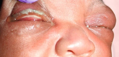 Gonococcal Conjunctivitis In New Born