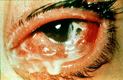 Gonococcal Conjunctivitis