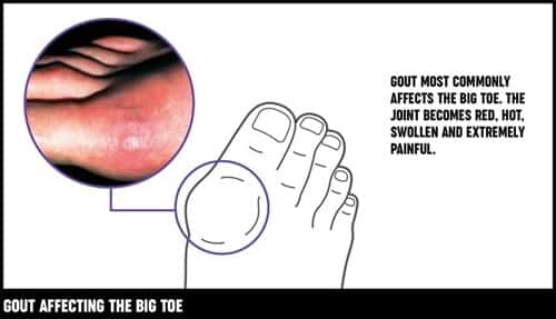 Gout Affecting The Big Toe