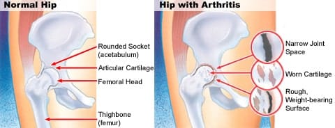Osteoarthritis Of Hip