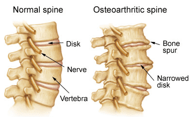 Osteoarthritis Of Spine