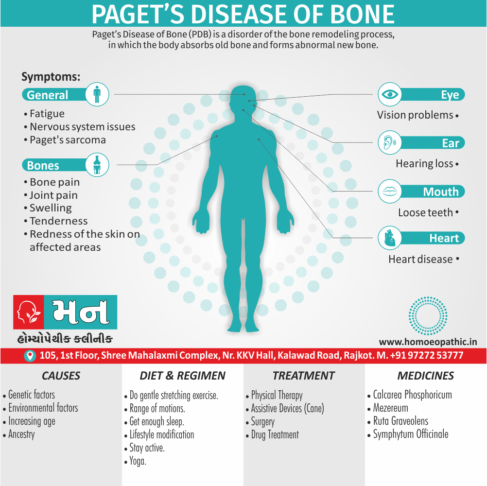 Paget’s Disease Of Bone Definition Symptoms Cause Diet Regimen Homeopathic Medicine Homeopath Treatment In Rajkot India
