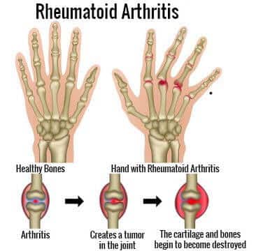 Rheumatoid Arthritis (RA) - homeopathy clinic in rajkot