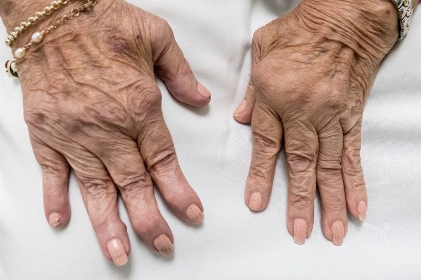 Rheumatoid Arthritis In Hands