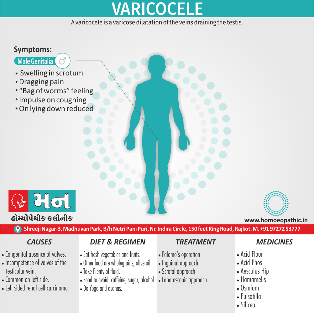 Varicocele