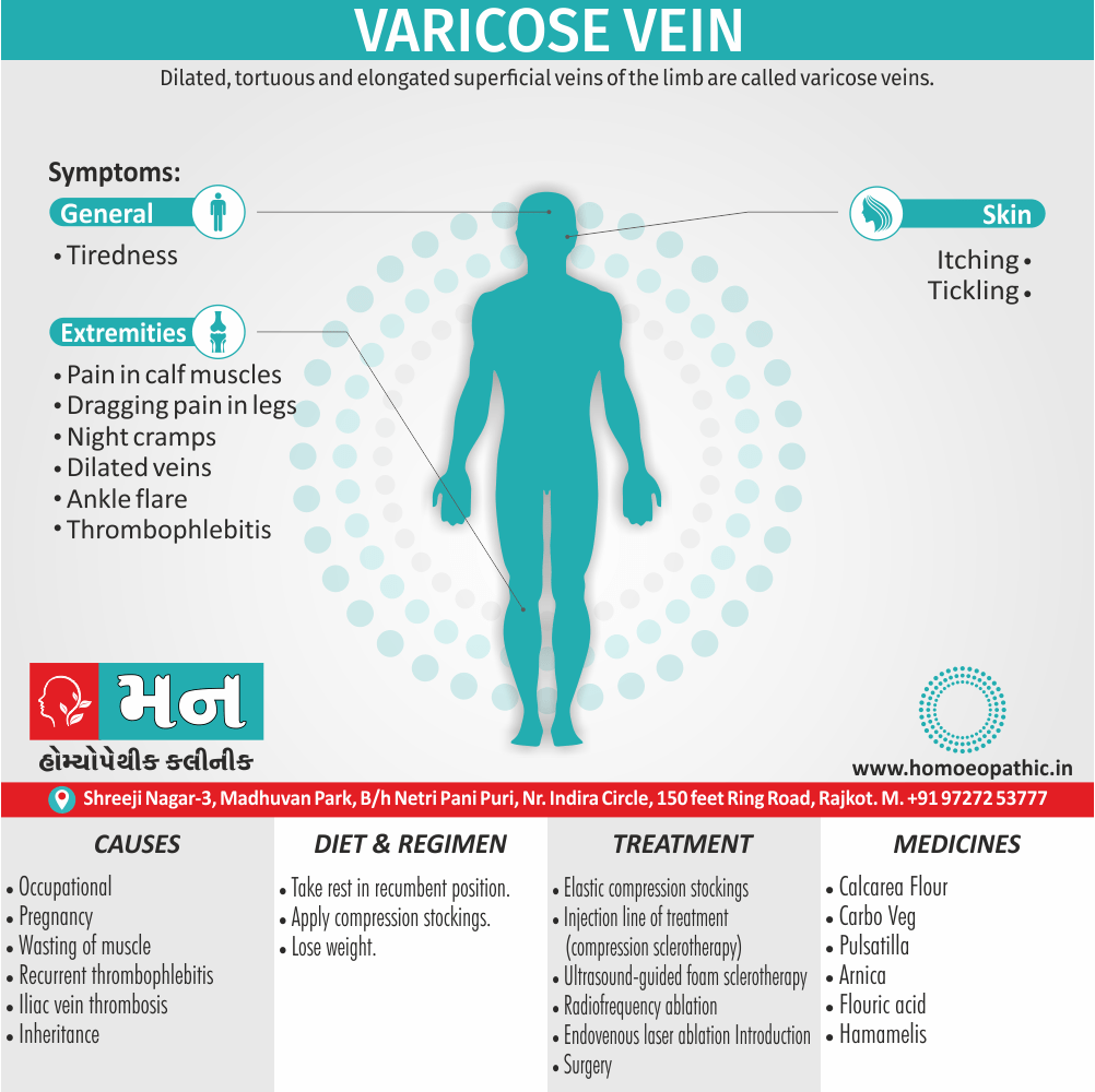 Varicose Vein Cause Diet Homeopathic Medicine Treatment Homeopathy Doctor Clinic in Rajkot Gujarat India